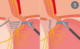 Closing the diaphragmatic hernia