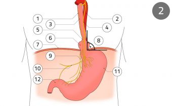 Diaphragmatic hernia in situ