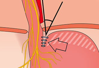 Illustration of the Bicorn procedure